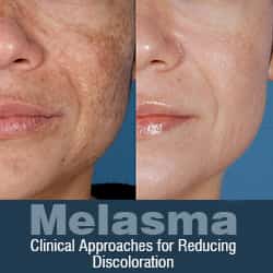 Melasma: Clinical Approaches for Reducing Discoloration